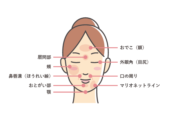 ヒアルロン酸注入