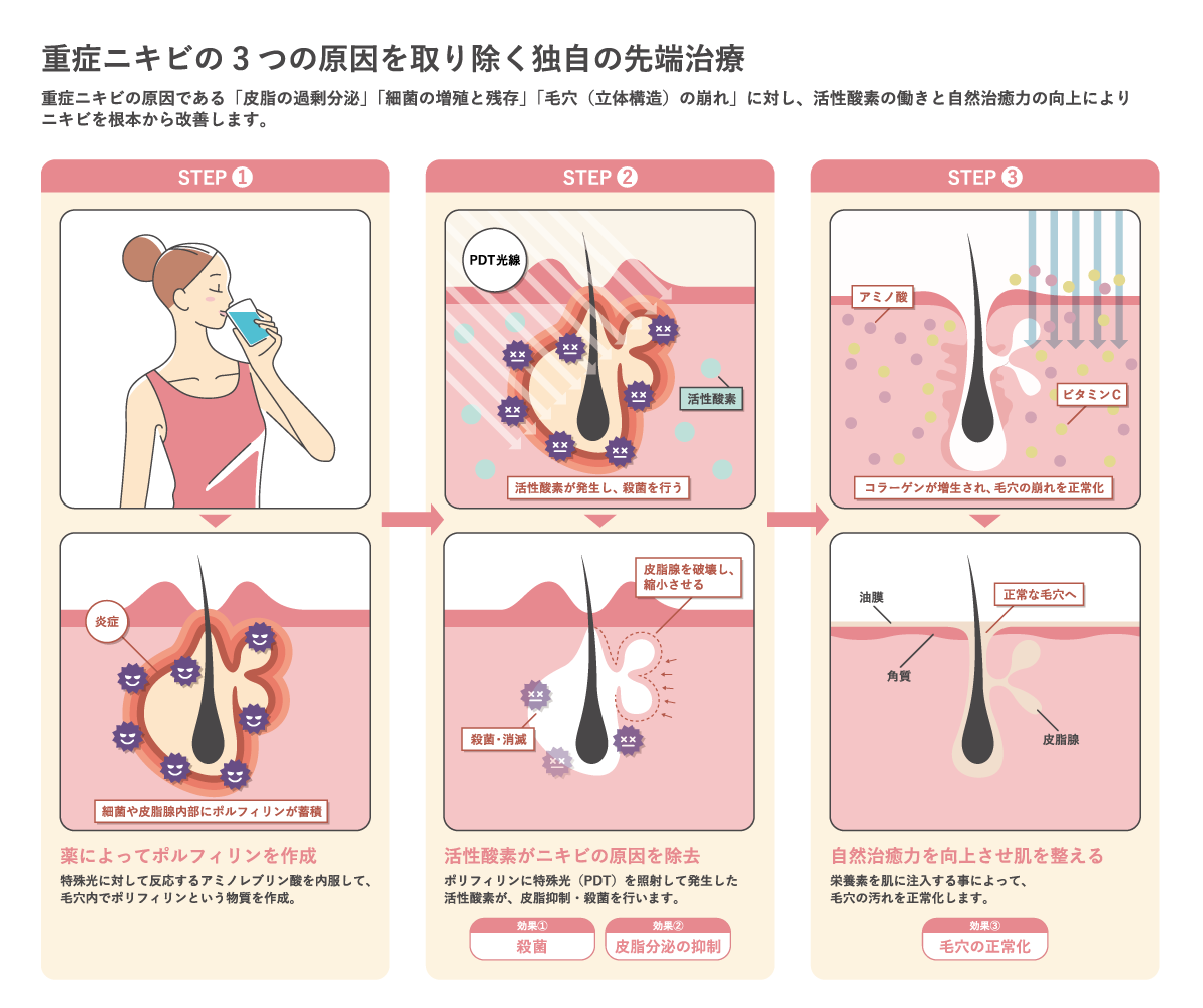 重症ニキビの3つの原因を取り除く独自の先端治療